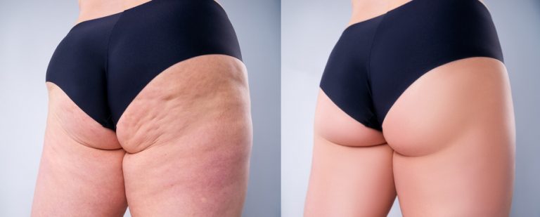 Tina (60 years old) defeated her cellulite with REDUSLIM